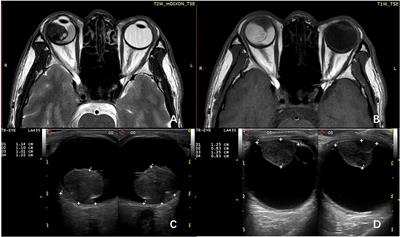 Circulating MicroRNAs as Quantitative Biomarkers for Diagnosis and Prognosis of Uveal Melanoma